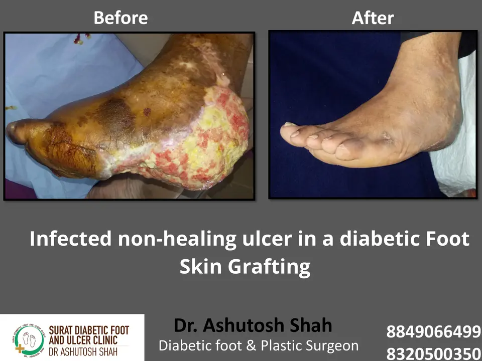 Diabetic Foot  PPT 3 checked by sir.pptx-13.webp